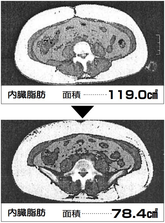 アカシアポリフェノールで内臓脂肪が30％以上減った