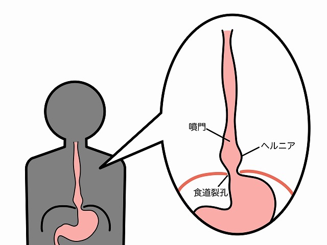 食道裂孔ヘルニアのメカニズム