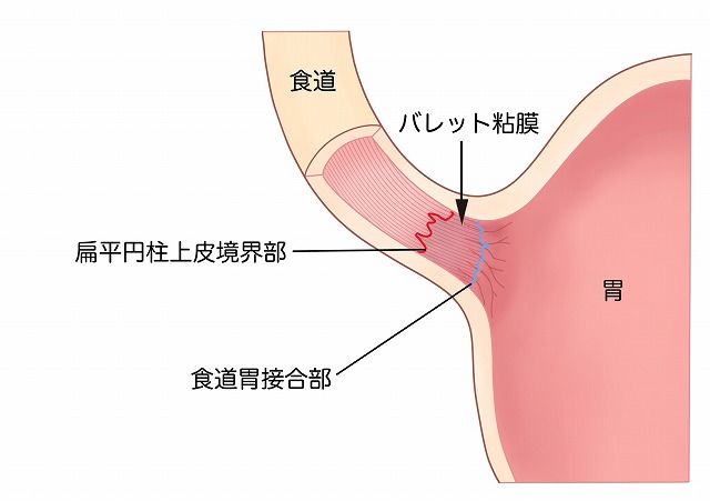 バレット食道とは